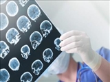 ضربه به سر ممکن است خطر مرگ زودهنگام را ۲ برابر کند