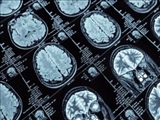 محققان روشی جدید برای ارسال دارو به درون مغز پیدا کردند