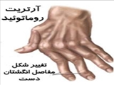 روماتيسم مفصلي چيست؟ 