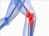 انجام پیوند غضروف زانو با روش اتولوگ برای اولین بار