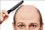 ژن‌های نادر عامل ریزش موی مردان شناسایی شدند