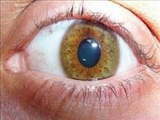 جراحي تغيير رنگ چشم مي تواند باعث کوري شود 