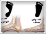 صافی کف پا و درمان آن 