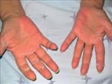 قرمزی كف دست ها از علایم تنبلی كبد است 