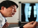 پزشک چینی، پیشگام جراحی بلند کردن قد