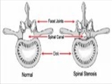  تنگی کانال نخاعی در ستون مهره کمری چگونه ایجاد میشود 