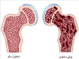 درمان پوکی استخوان با یک ایمپلنت کوچک 