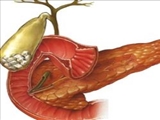 سنگ کیسه صفرا درمان دارویی ندارد