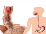 افزایش خطر سرطان مری با تغذیه ناسالم